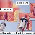 hemoroid nedir