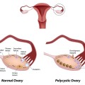 polycystic ovary sendromu